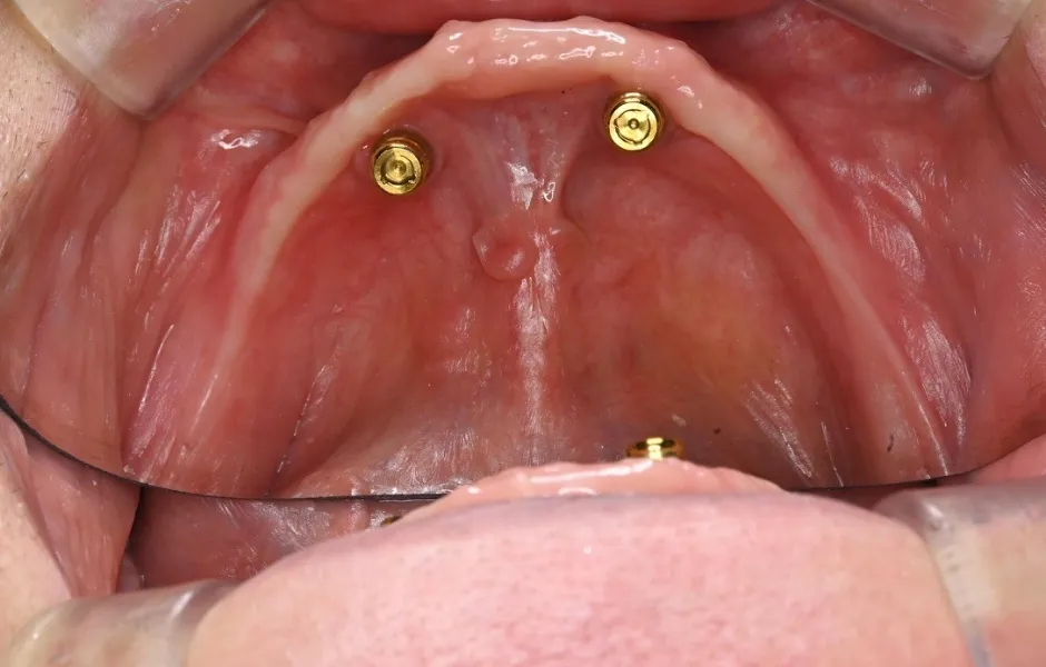 治療前のインプラントオーバーデンチャーのイメージ