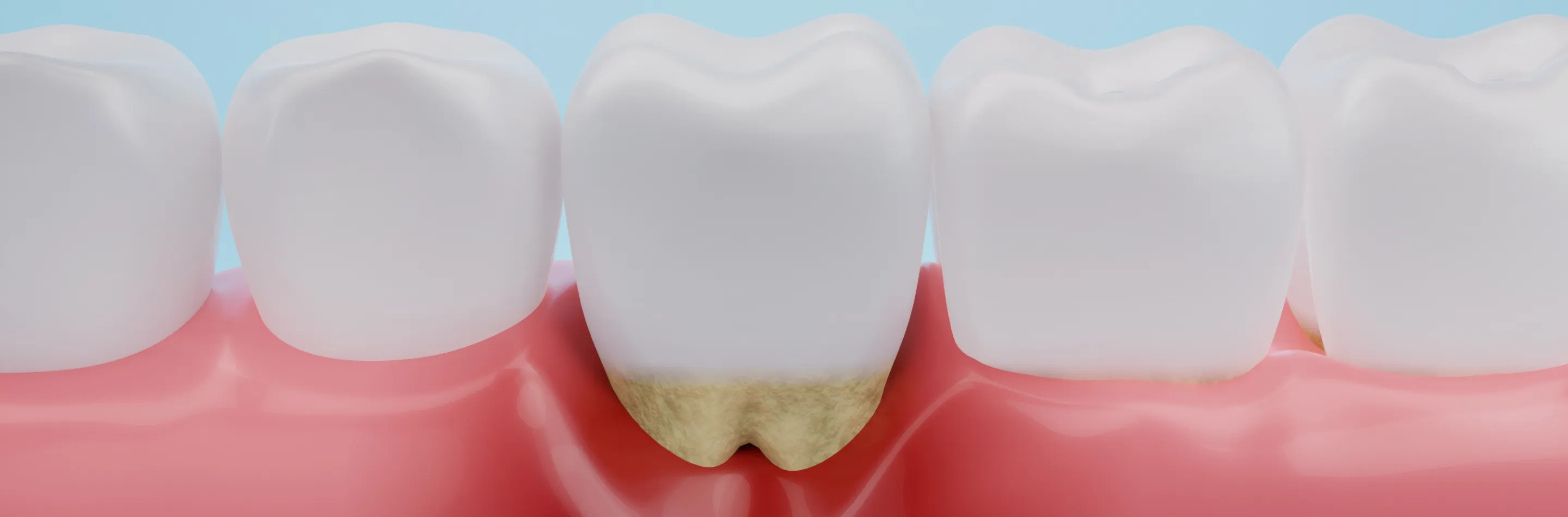 歯周病治療のキービジュアル