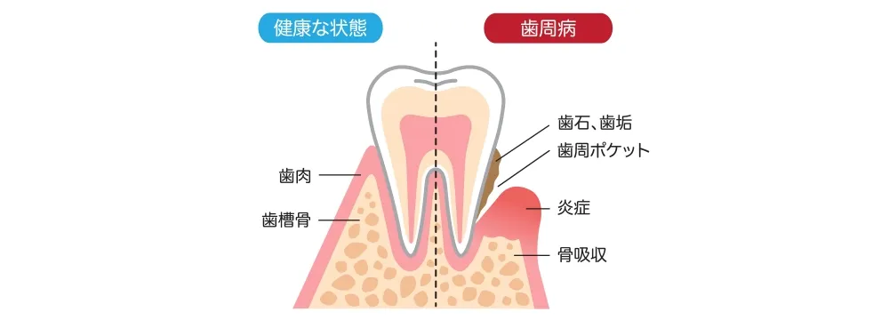 歯周病のイメージ