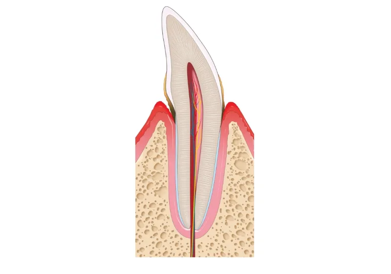 歯周病の進行段階2 軽度歯周炎