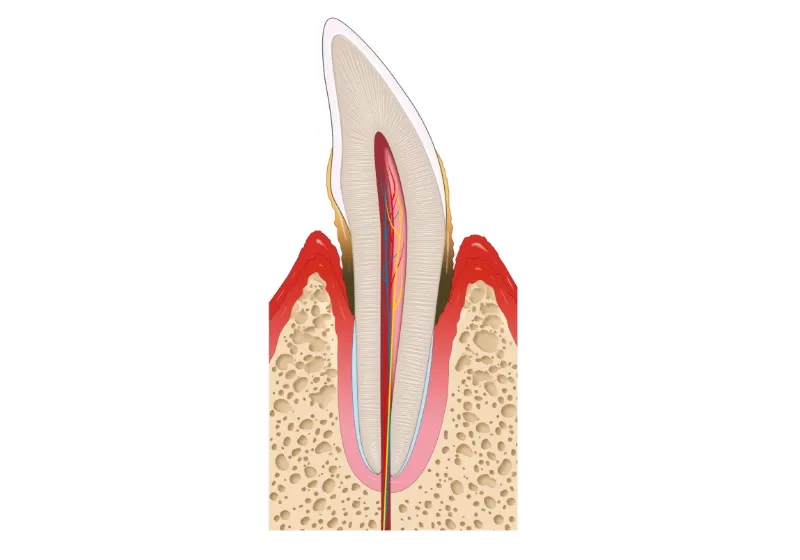 歯周病の進行段階3 中等度歯周炎