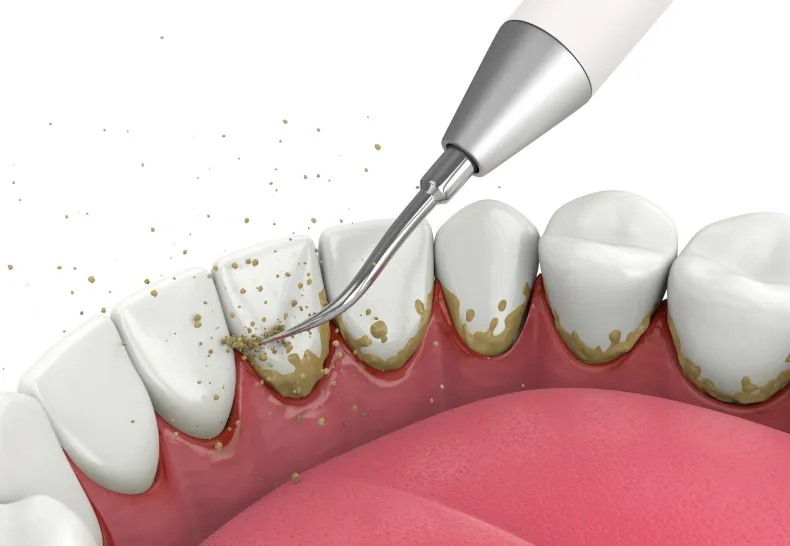 SRP(スケーリング・ルートプレーニング)のイメージ