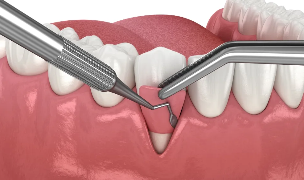歯周病治療の特長のイメージ
