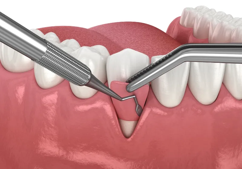 外科治療(必要な場合)のイメージ
