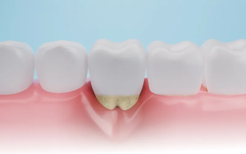 手遅れになる前に歯周病からあなたの大切な歯を守りましょう