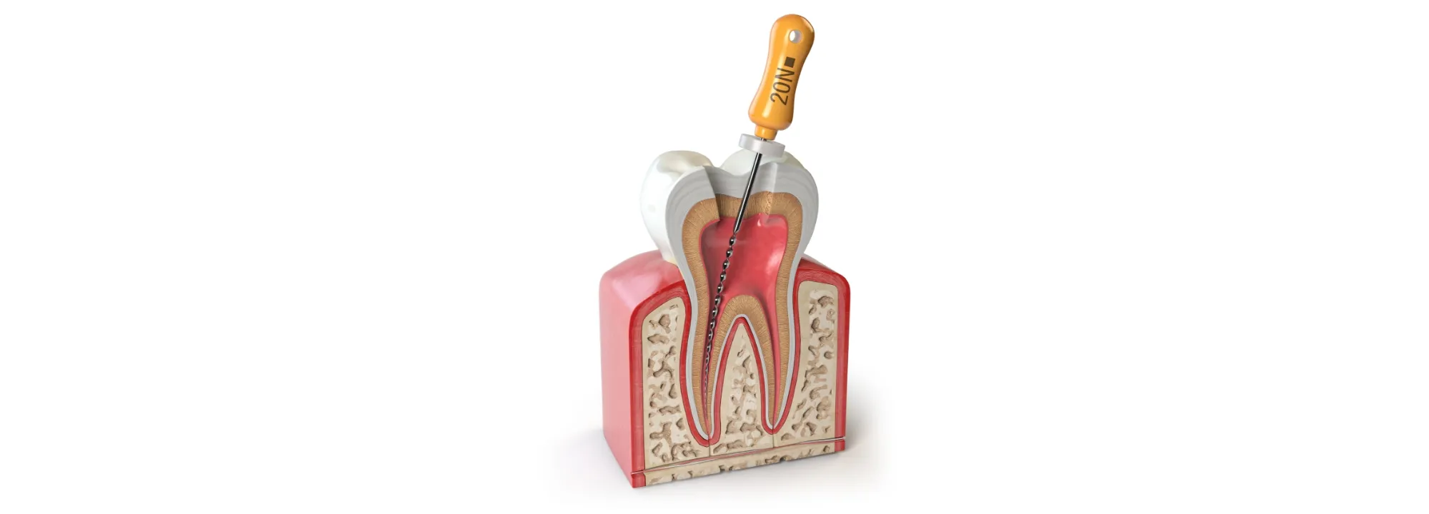 歯の「根っこ」の治療、根管治療とは？