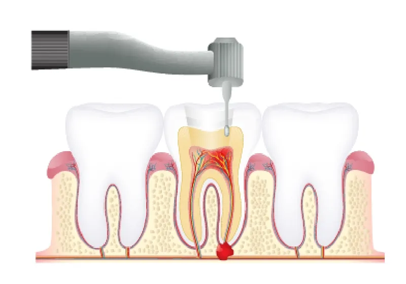 根管治療の流れ2 虫歯感染した神経の除去と根管拡大