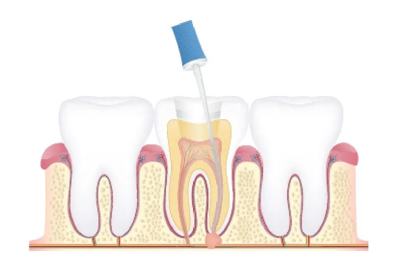 根管治療の流れ3 根管内の洗浄