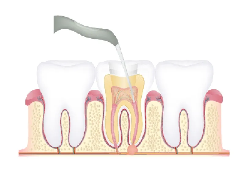 根管治療の流れ4 仮封と治療間隔