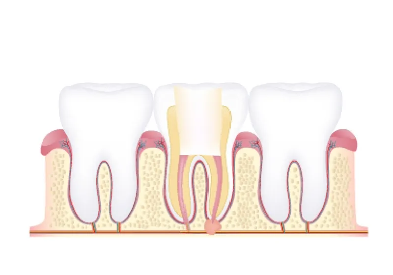 根管治療の流れ5 根管充填被せ物の形作り