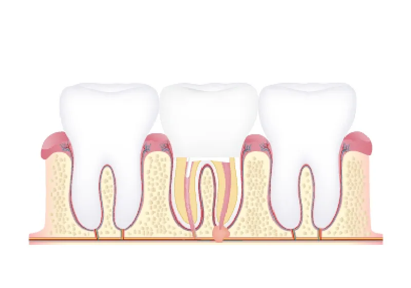 根管治療の流れ6 最終補綴と予防