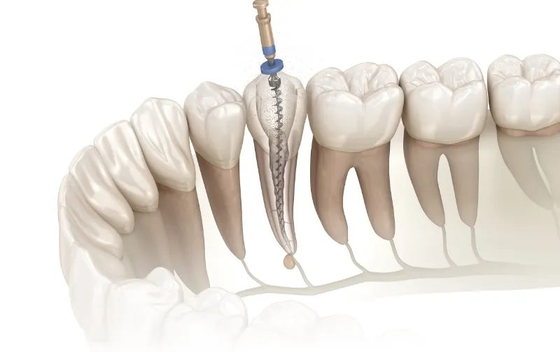 根管治療について、まずは問い合わせしてみる