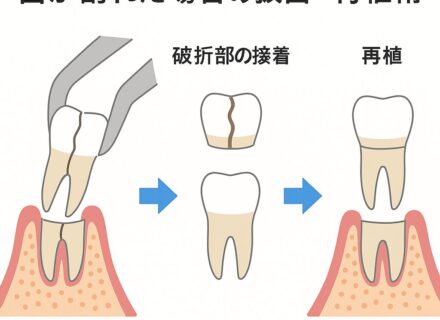 🦷 根管治療後の歯が割れたら？ 「再植」で歯を救えることがあります （堺市北区・MYデンタルクリニック）