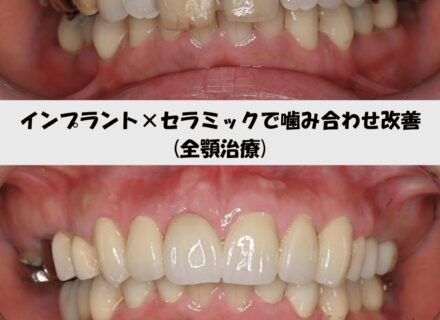 【症例紹介】インプラント×セラミック｜矯正なしで噛み合わせと見た目を改善