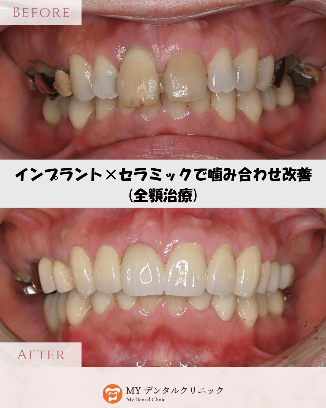 症例紹介】インプラント×セラミック｜矯正なしで噛み合わせと見た目を改善